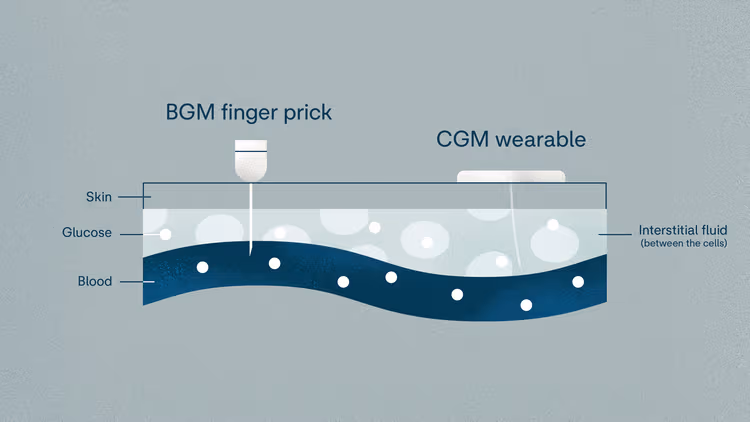 BGM vs CGM