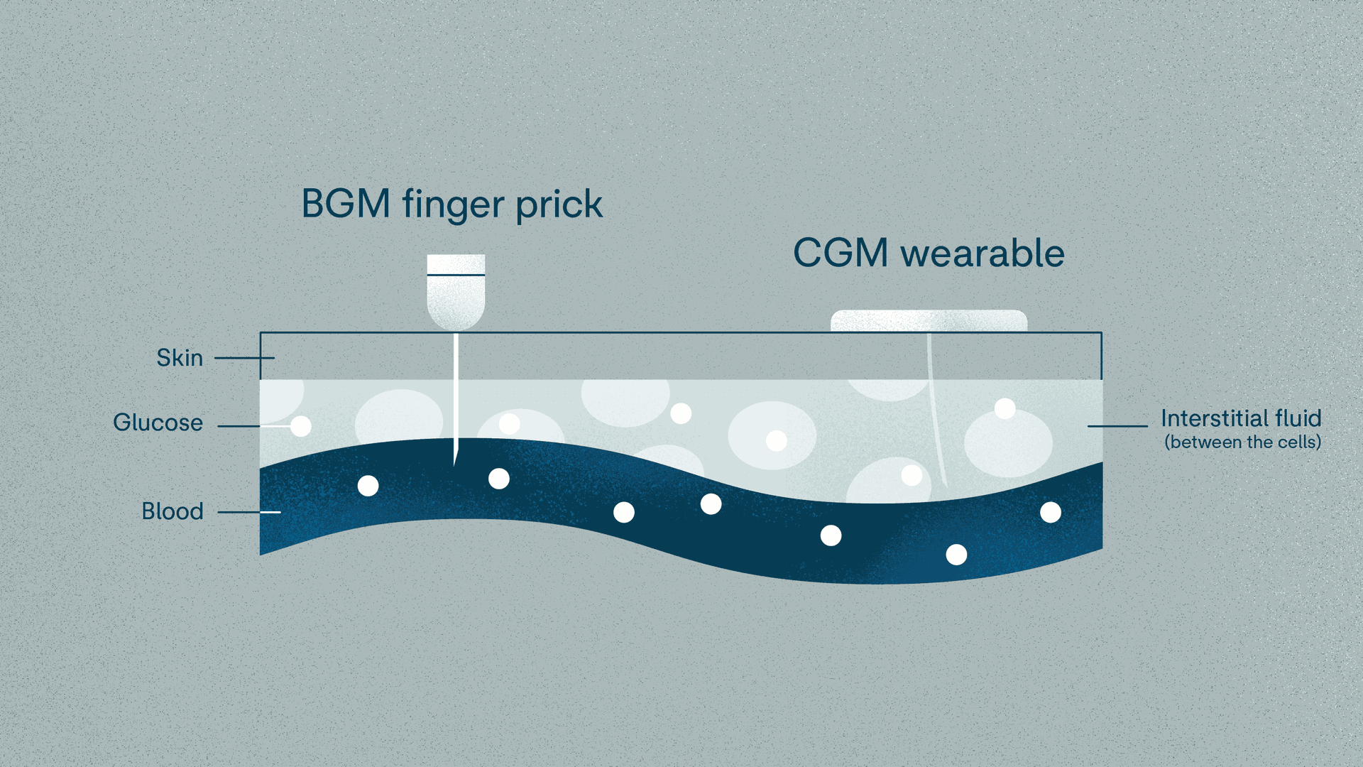 BGM vs CGM