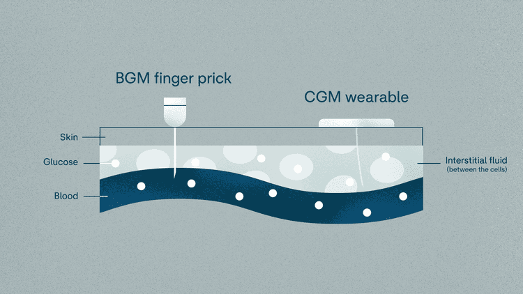 BGM vs CGM
